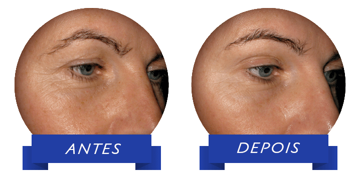 Redução visível de volume das rugas dos olhos após 8 semanas da ingestão de 2,5g do Verisol®. Exemplo de 1 participante antes e depois do tratamento (Proksch et al., 2014).
