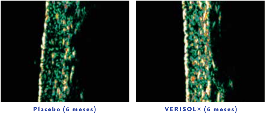 Densidade da Derme (imagem de ultrassom) após 8 semanas da ingestão de 2,5g do Verisol® (Schunck, et al., 2015).