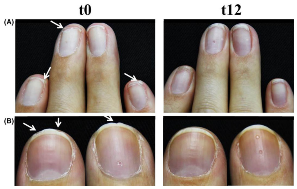 Registro da descamação e irregularidade das bordas das unhas antes (t0) e após 12 semanas (t12) de tratamento com 2,5g Verisol® ao dia. Exemplo de 2 participantes (A e B) (Hexsel et al., 2017).