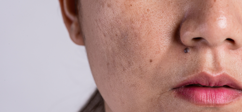 4 passos para clarear o melasma no rosto