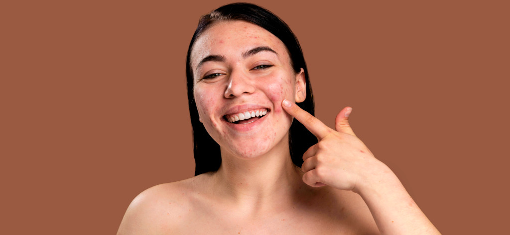 Cicatrizes de acne: Tratamentos inovadores para uma pele rejuvenescida