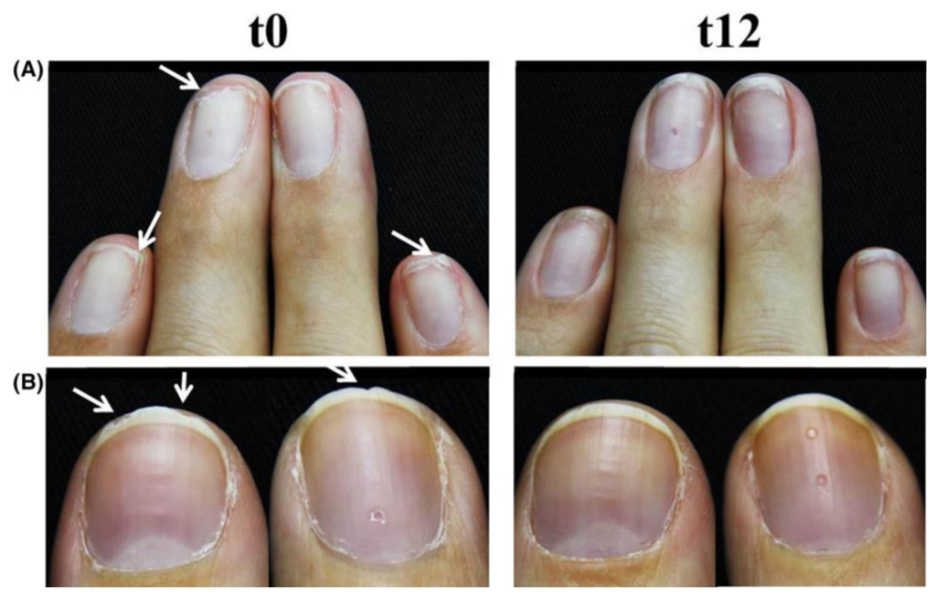 Registro da descamação e irregularidade das bordas das unhas antes (t0) e após 12 semanas (t12) de tratamento com 2,5g Verisol" ao dia. Exemplo de 2 participantes (A e B) (Hexsel et al., 2017).