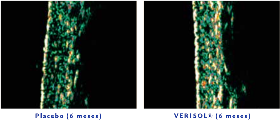 Densidade da Derme (imagem de ultrassom) após 8 semanas da ingestão de 2,5g do Verisol®